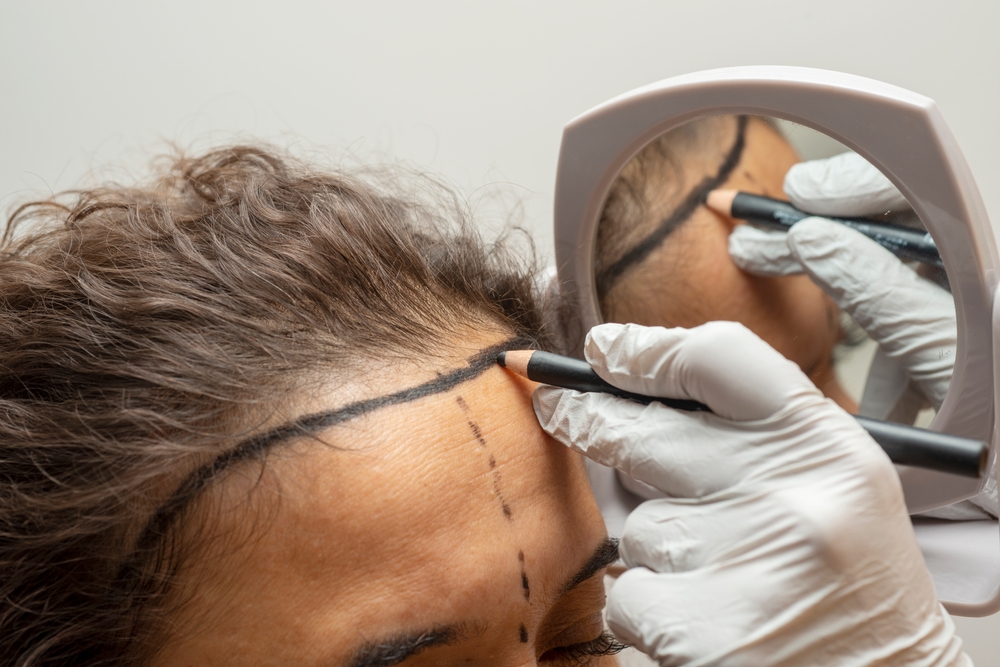 Hair Transplant Cost: What You Should Expect to Pay in 2025