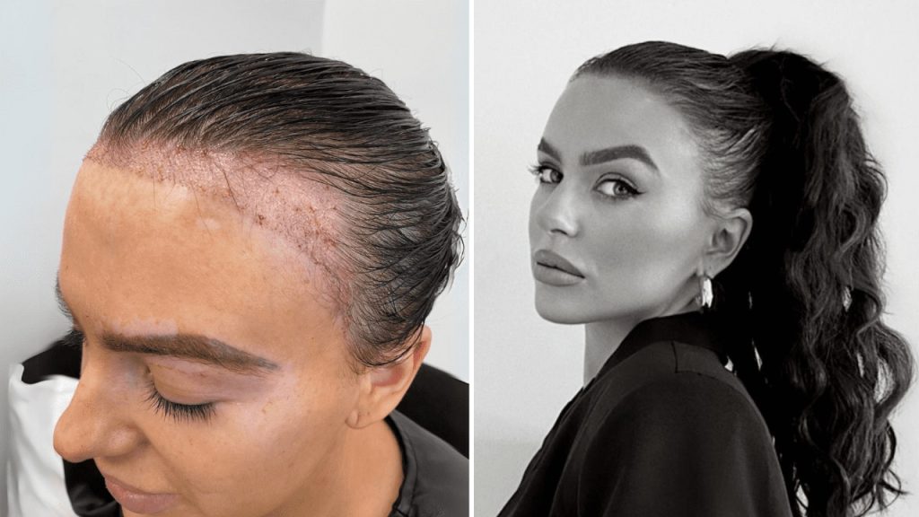Hair transplant birmingham
