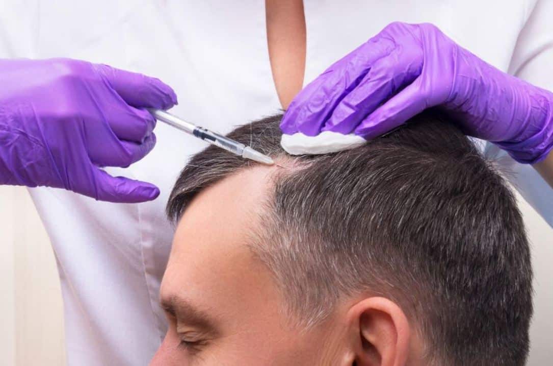 Hair Transplant London – Get the Ultimate Natural Look