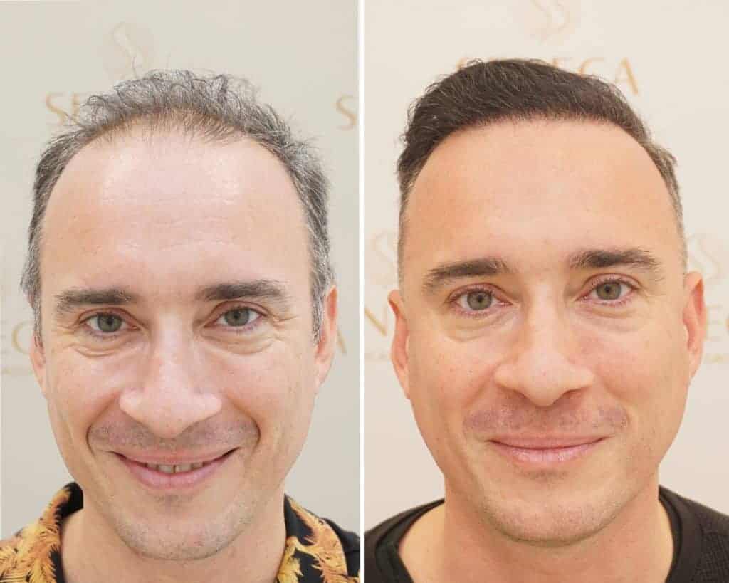 Hair transplant uk